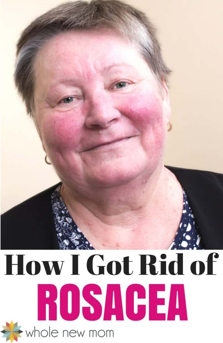 After struggling with rosacea for a long time, I found a natural rosacea remedy that really works! Find out how to get rid of rosacea here.