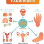 candidiasis diagram