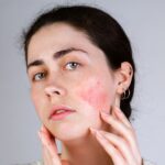 woman with rosacea and facial redness.